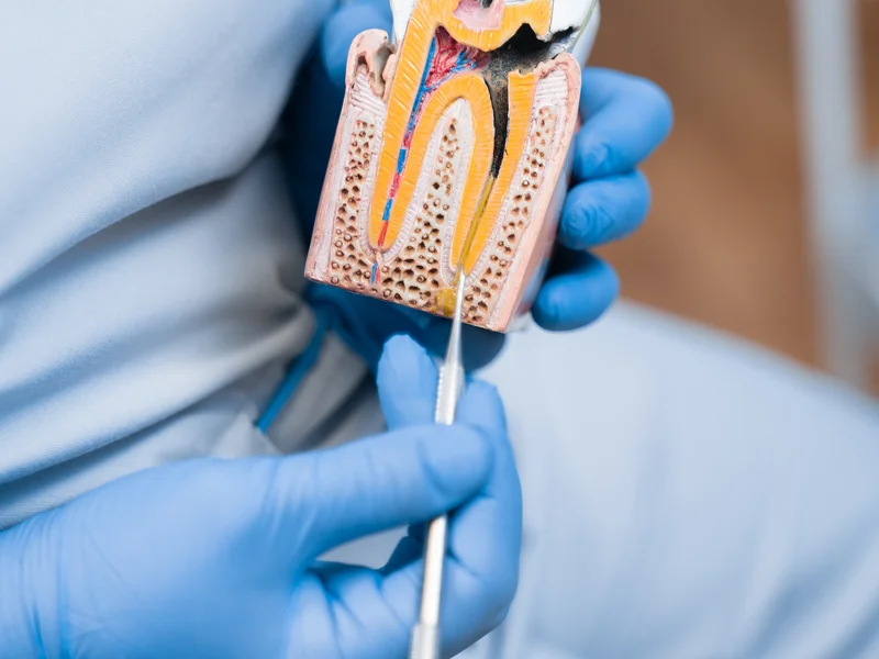 Immagine di un finto dente cariato